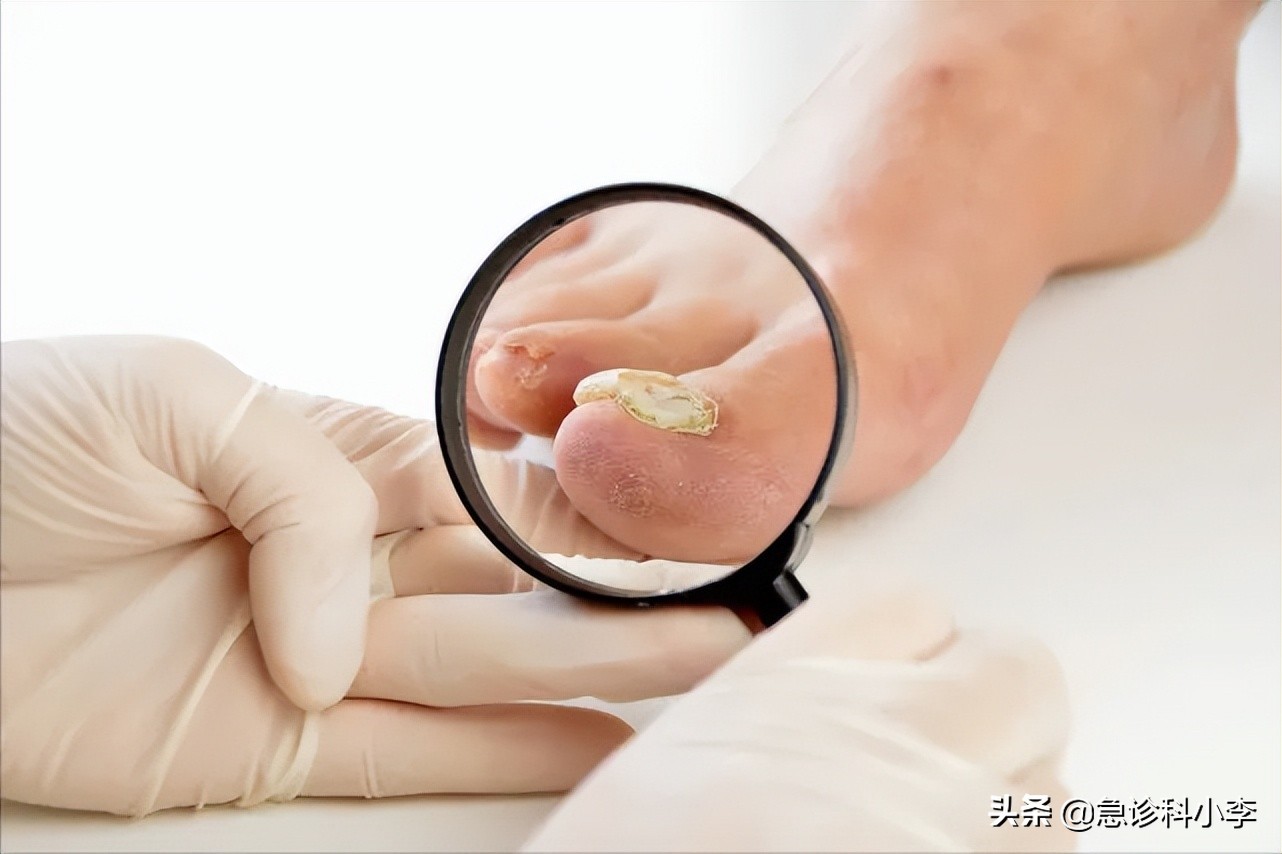 脚趾甲老往肉里钻,脚趾甲总是往肉里钻怎么办