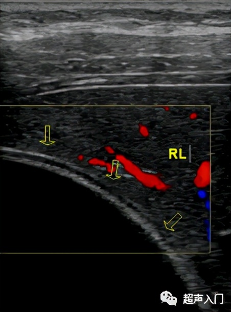 肝包虫病b超能检查出来吗,肝纤维化b超能检查出来吗
