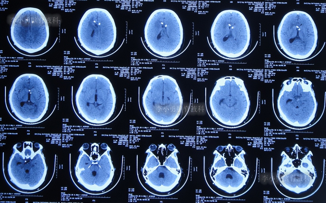脑积水三脑室造瘘多久能恢复,脑囊虫手术后脑积水