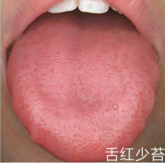 一招判断肾阴虚还是肾阳虚女性,怎么分辨肾阴虚还是肾阳虚