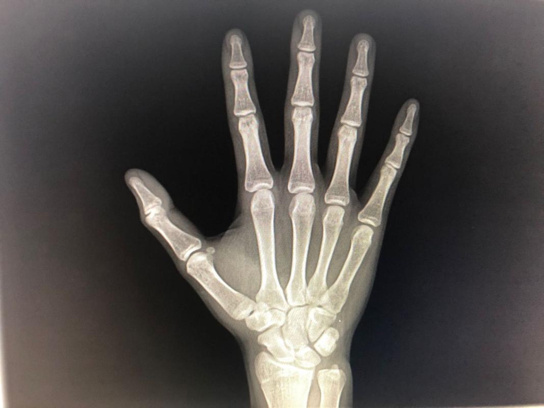 骨龄提前又不高能打生长激素吗,骨龄超前身高偏矮