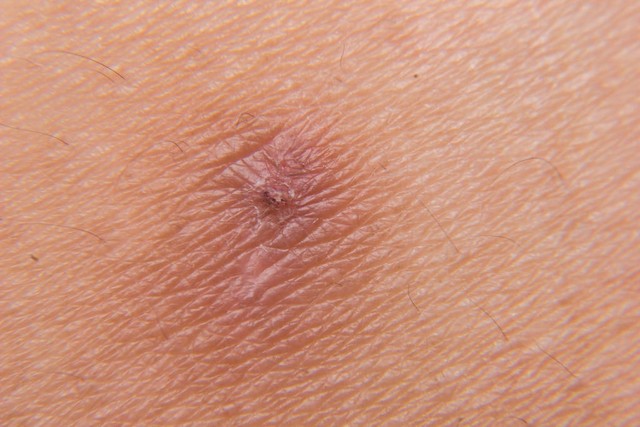 女性胸部能摸到硬块，小心乳腺癌，乳腺癌会出现这6个症状