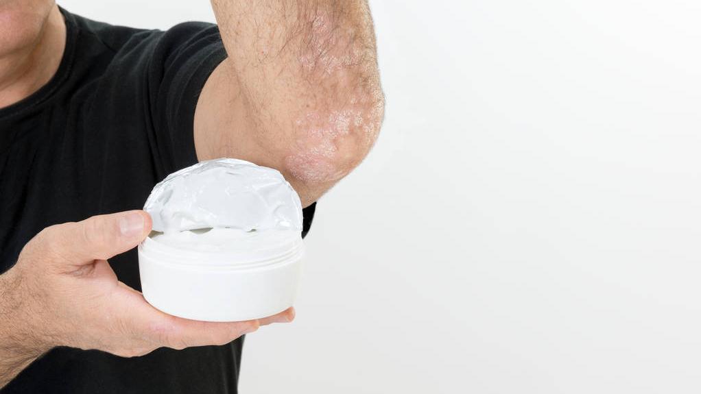 身上有一块白癜风头发也会变白吗,身上长了五处白癜风白斑严重吗