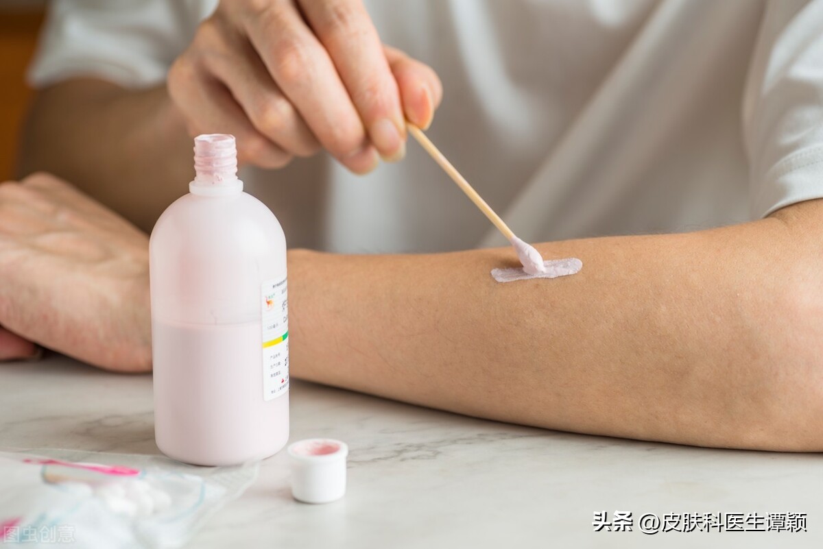 皮肤科医生和你聊聊：炉甘石洗剂可以治疗什么？有什么注意事项？