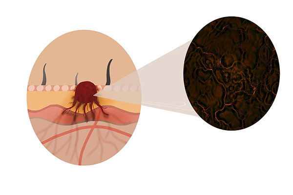 钇90微球抗癌新药价格,钇90治疗肝癌最新价格