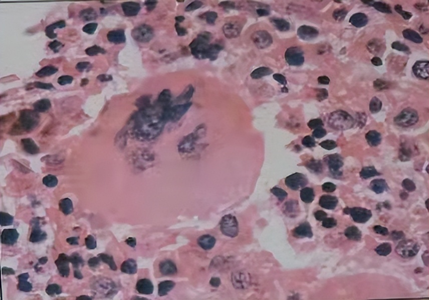 脂肪肝血液异常,脂肪肝的血常规表现