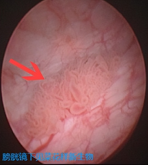 泌尿系肿瘤有什么特征,泌尿系肿瘤有什么症状严重吗