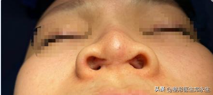 女子花7000去美容不料整成红鼻子,美容整鼻子事件