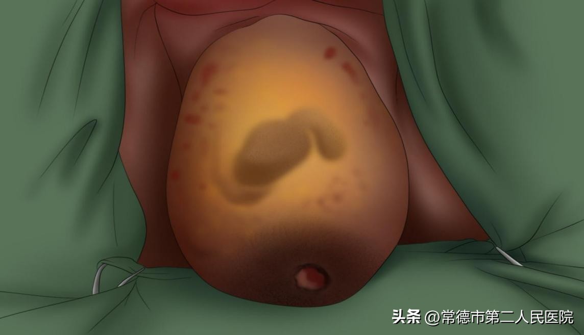 子宫脱垂掉出来一块肉,女性的难言之隐子宫脱垂