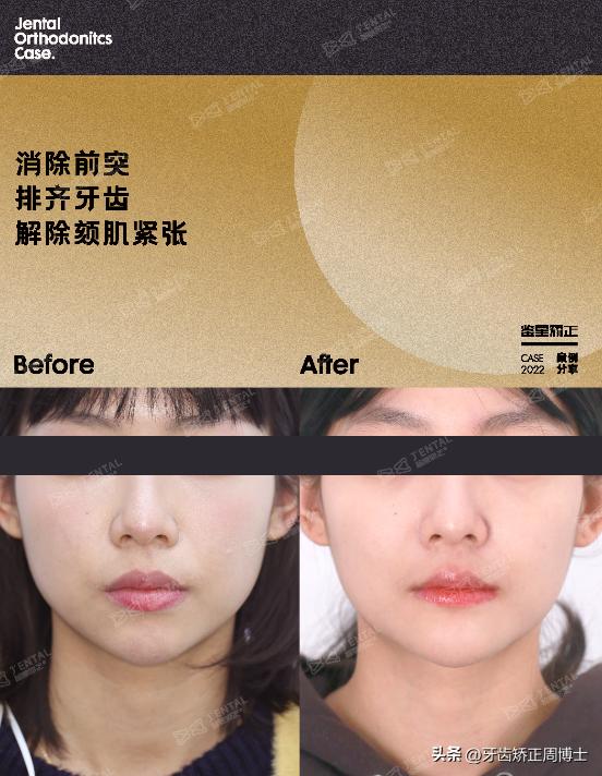 骨性龅牙矫正牙齿变小了,骨性龅牙已经做了正畸手术怎么办