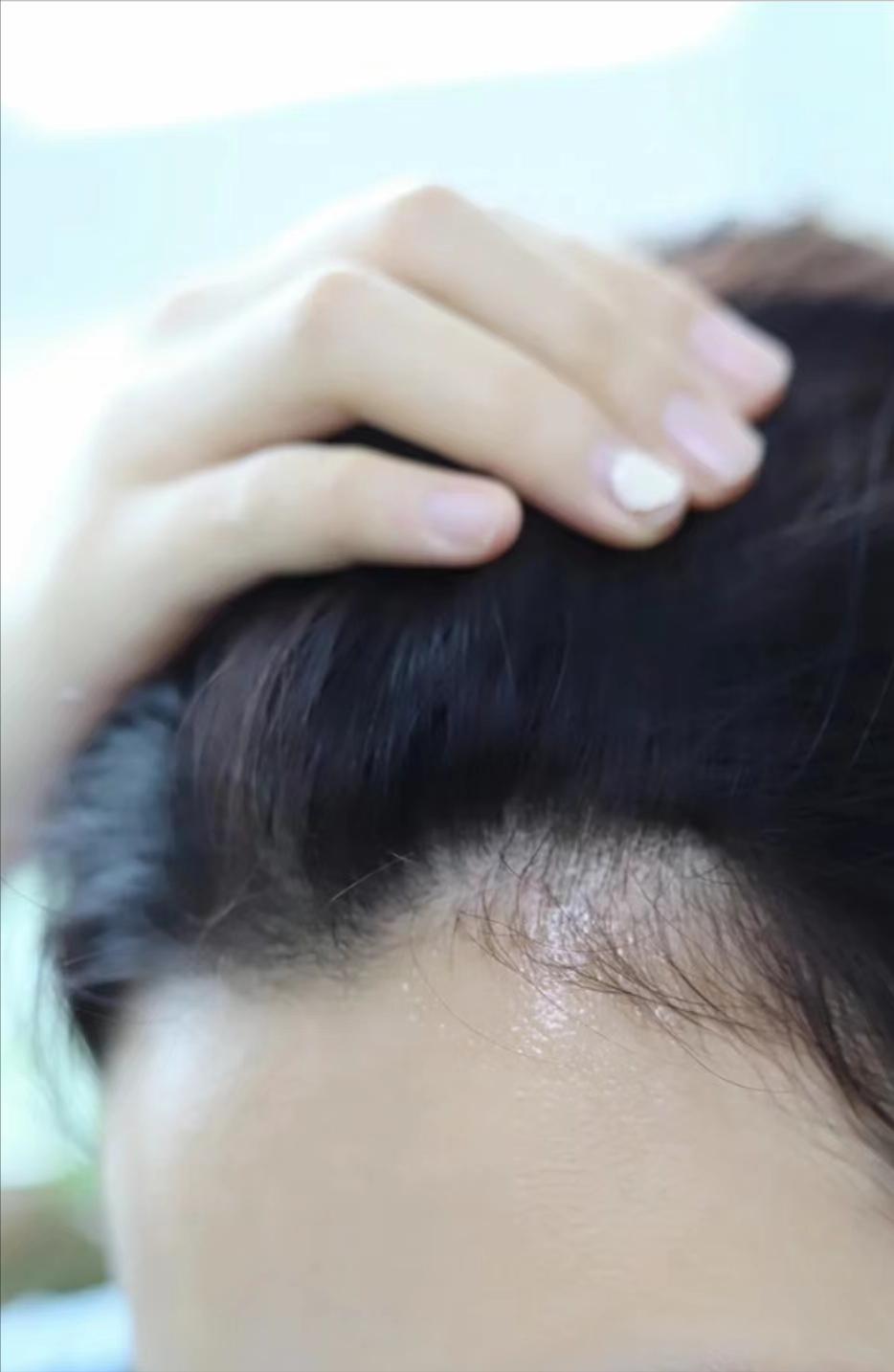 米诺地尔打卡第五天,米诺地尔每日打卡