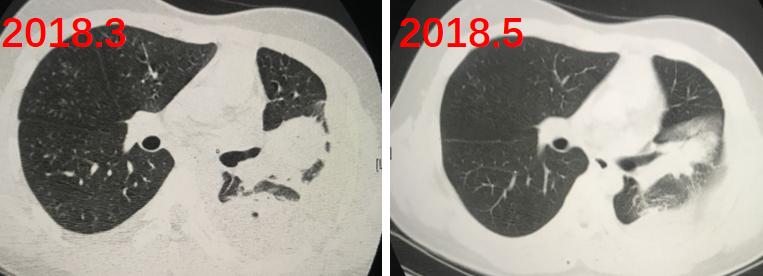 免疫缺陷病会并发什么病,什么是免疫缺陷肺部感染