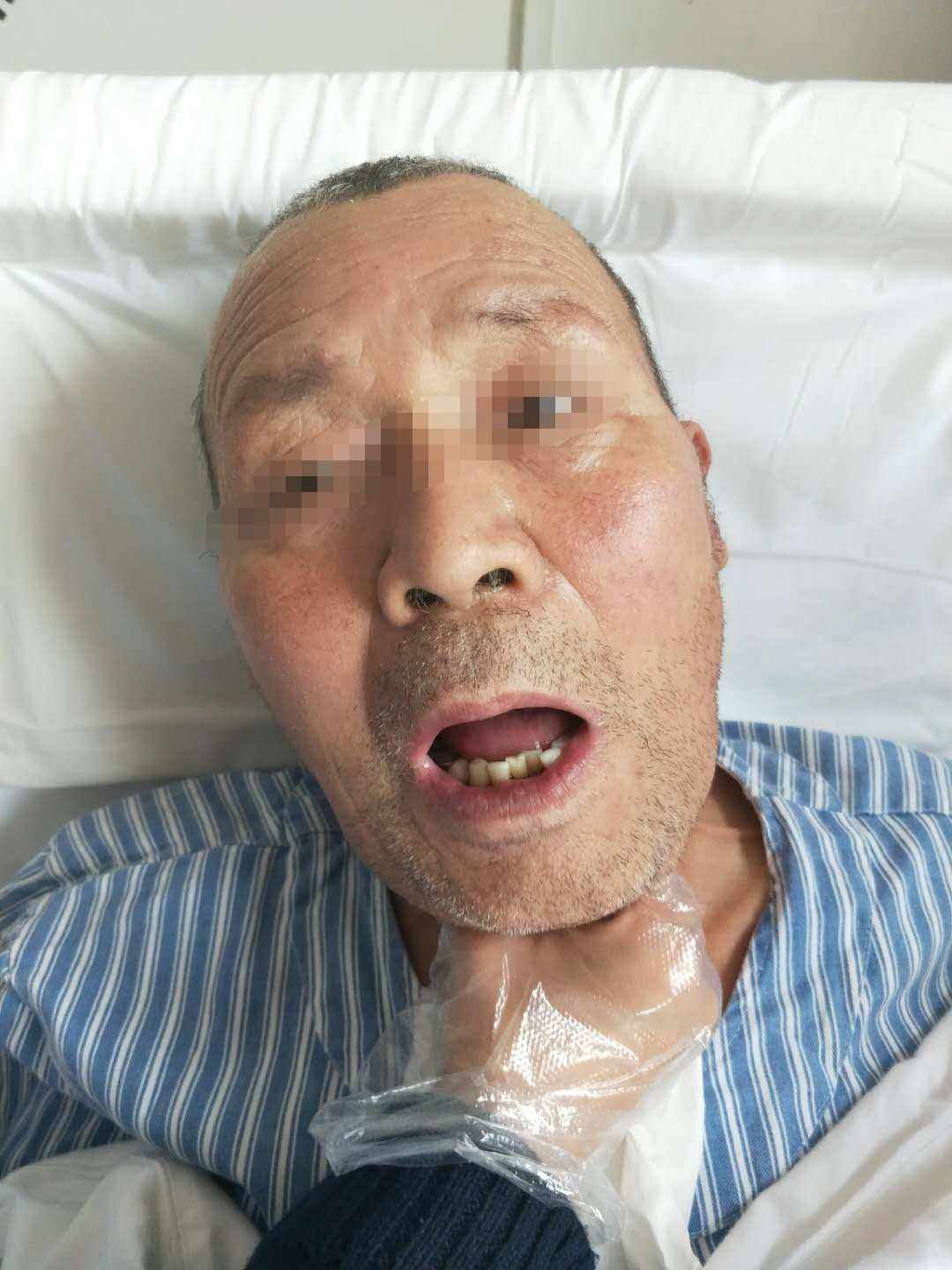 加速康复外科在围手术期的应用,加速康复外科围手术期营养支持