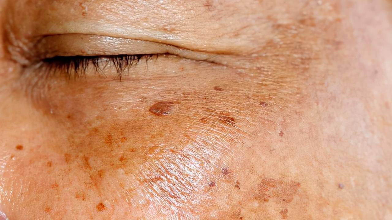 维生素e真的能淡斑吗,维生素e加牛奶真的可以祛斑吗