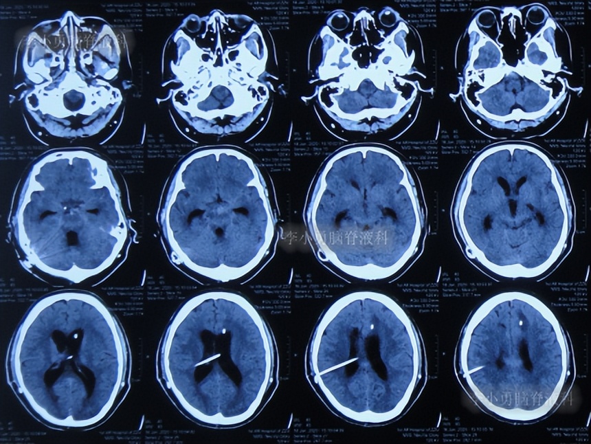 脑积水三脑室造瘘多久能恢复,脑囊虫手术后脑积水
