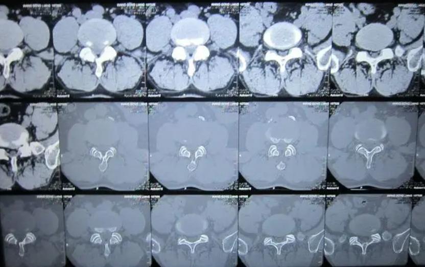 腰突症纯中药能治愈吗,腰突症急性期用什么中药