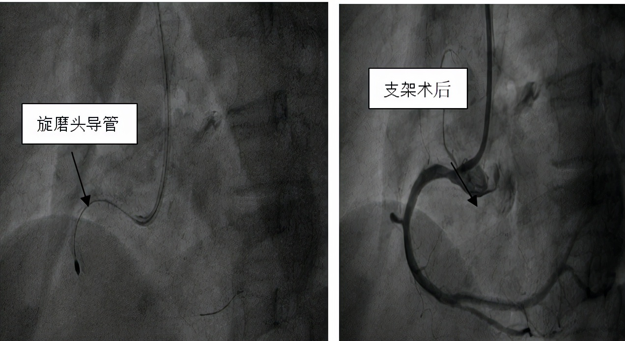 冠状动脉旋磨术,冠状动脉血管旋磨疏通手术