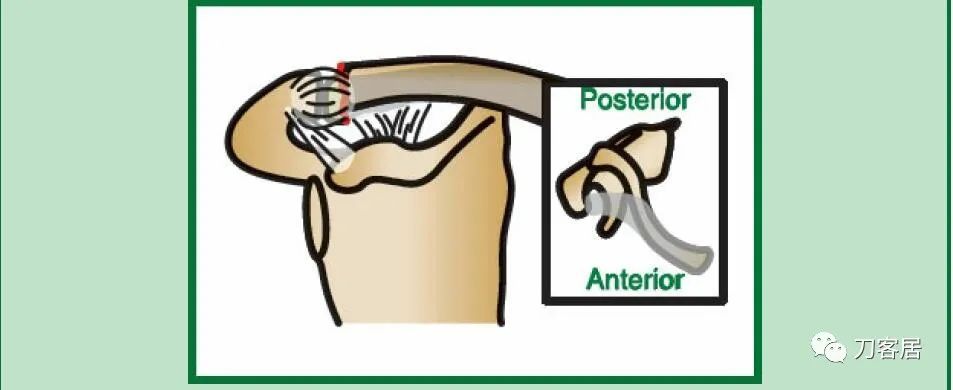 儿童锁骨骨折保守治疗的弊端,锁骨粉碎骨折错位不处理会愈合吗