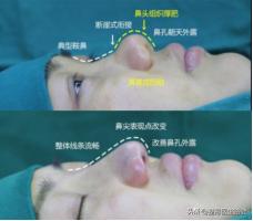 隆鼻后为什么没用夹板,隆鼻后鼻头感觉有点歪怎么办