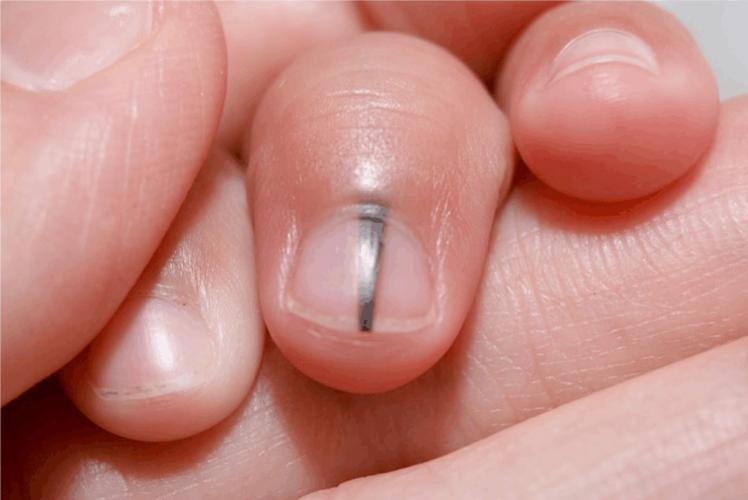 黑痣上长毛是好痣还是坏痣,脸上有个凸出的黑痣是好痣吗