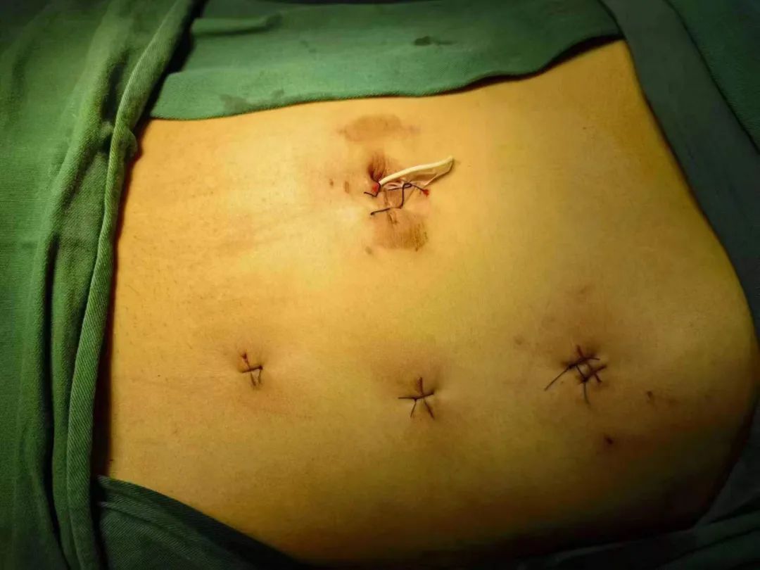 隆回县人民医院:患者身上怪味从何来?原来是“脐膀胱瘘”在作怪