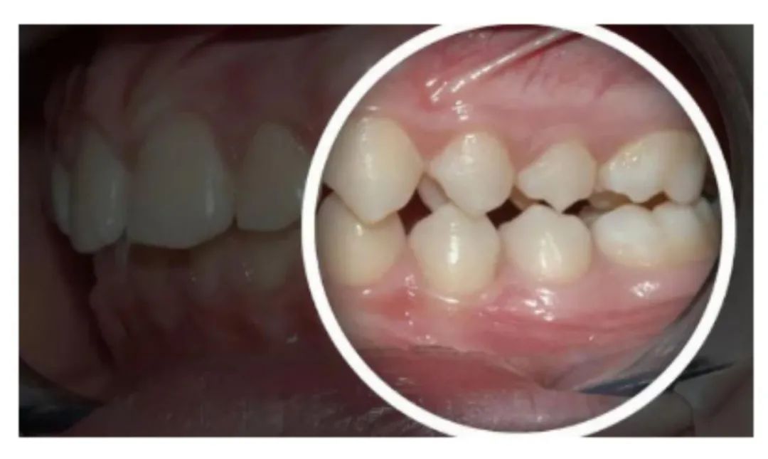 吃东西总咬腮帮肉是怎么回事,吃东西总是咬嘴看什么科