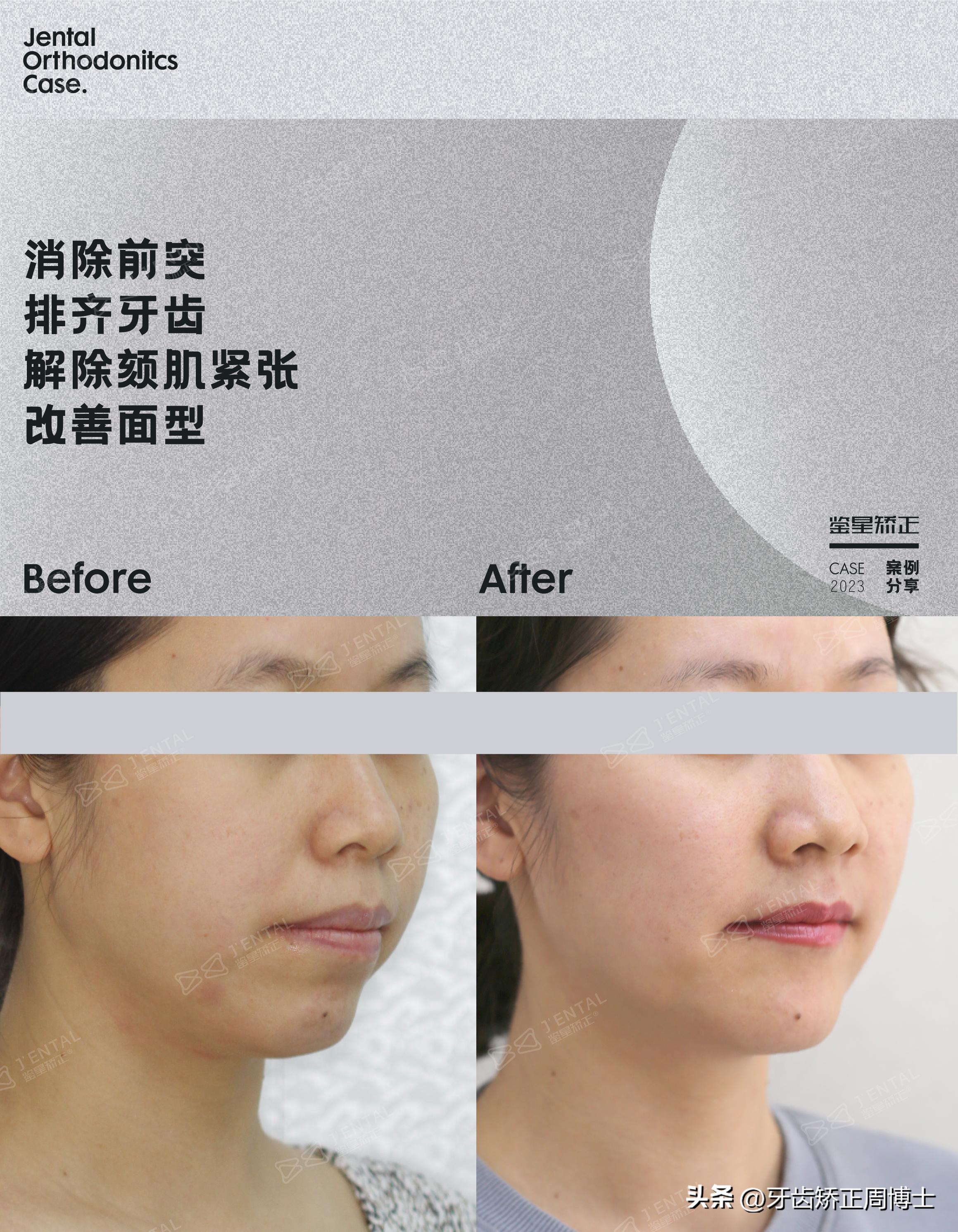 骨性龅牙怎么通过普通的矫正改善,骨钉如何解决骨性龅牙