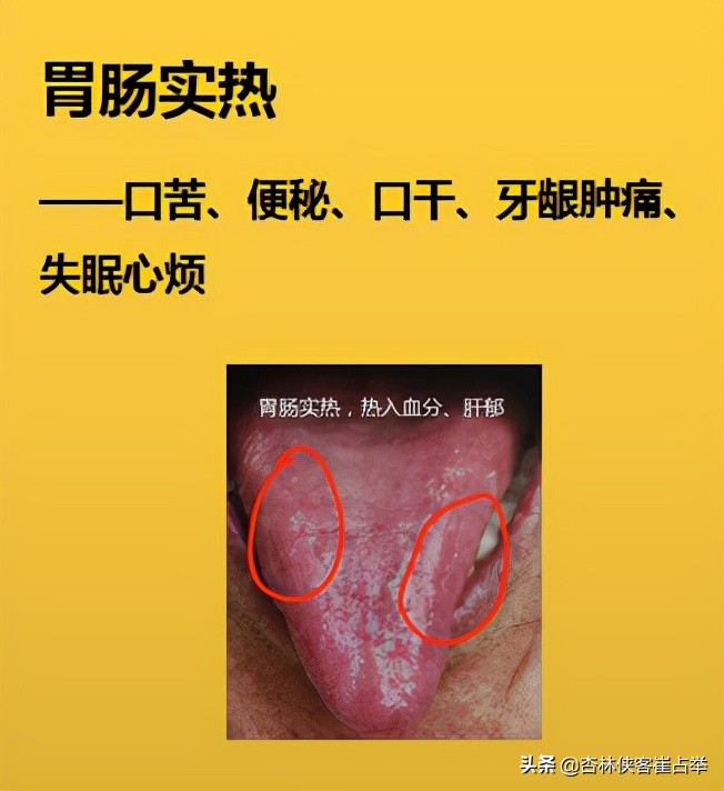 心火肝火胃火旺盛的表现症状,肝火胃火旺怎么从舌头上看出来