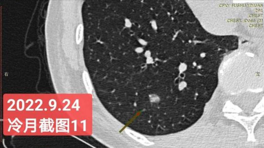 7mm肺结节恶性的怎么办,7mm实性肺结节危险程度