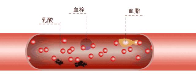 血瘀体质易得心梗吗,血瘀体质容易心梗