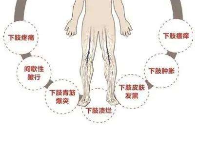 缓解静脉曲张简单实用不花冤枉钱,精索静脉曲张吃药能缓解疼痛吗