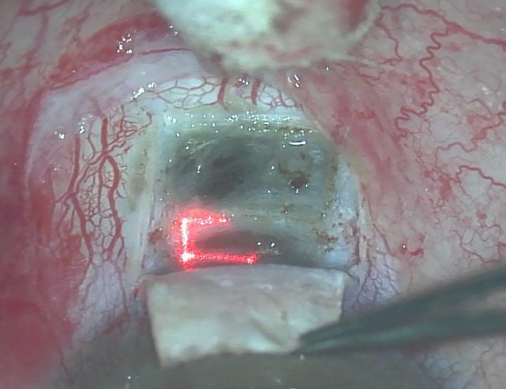 哈医大一院眼科医院专家手术,哈医大一院眼科白内障手术