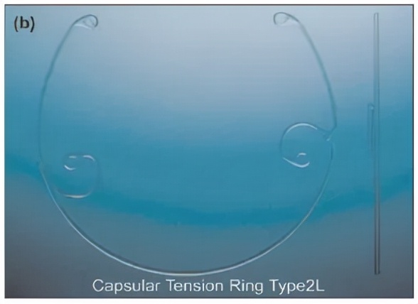囊袋张力环的选择,囊袋张力环与预装式张力环