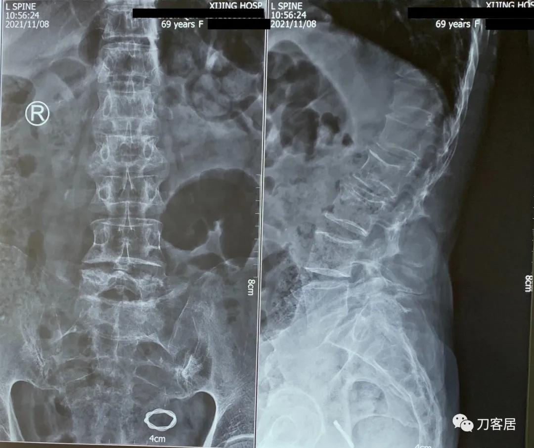 老年人腰骨裂不手术怎么治疗最好,老年腰椎骨质疏松症