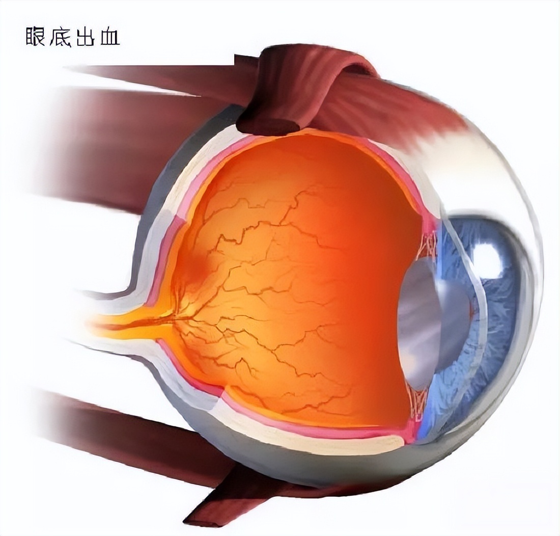 眼底出血术后忌什么中药,眼底出血中医有好办法吗