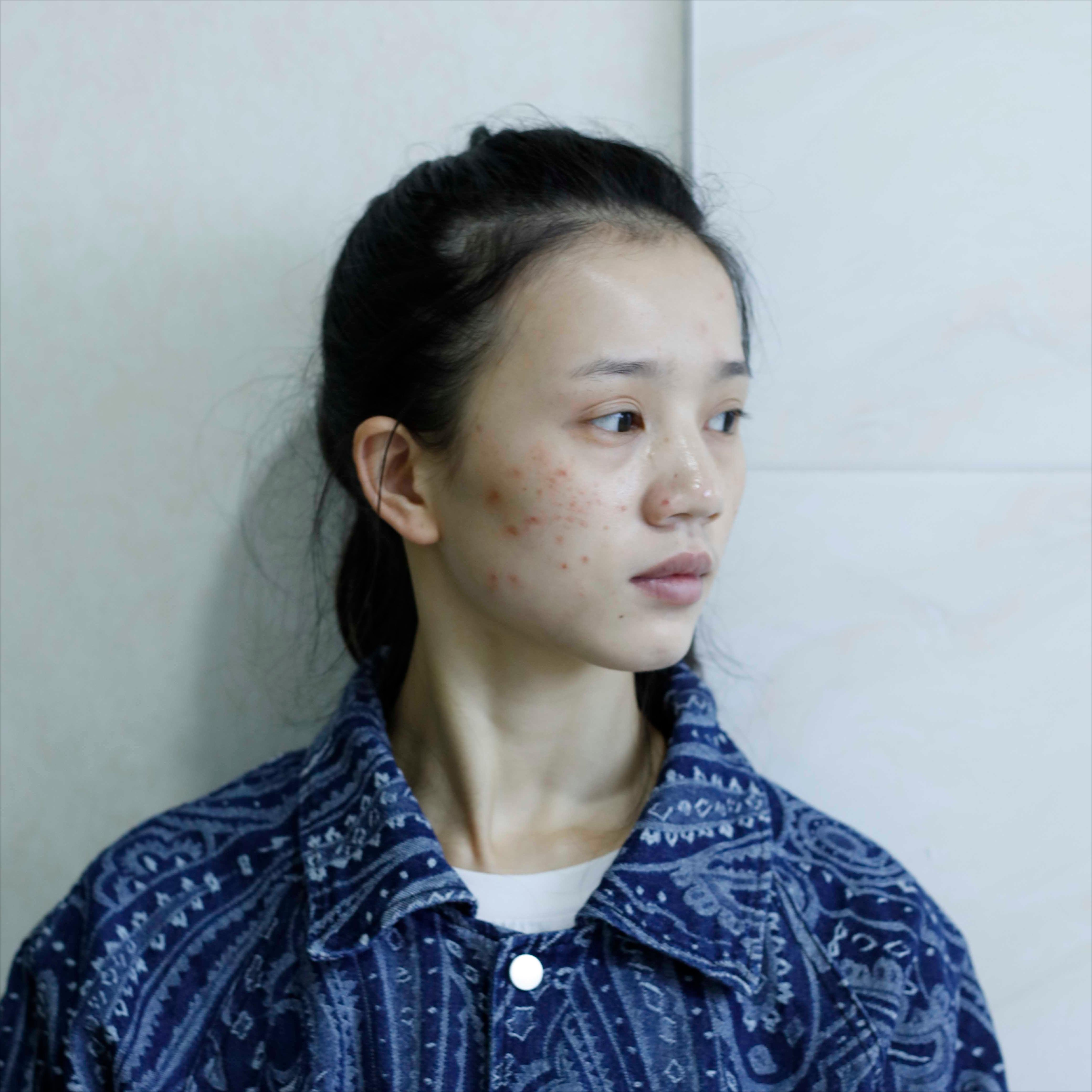 再漂亮的小姐姐也会被痘印困扰，治疗完后感叹激光治疗效果真不错