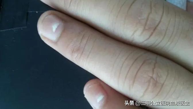 手指甲发白没有月牙有明显竖纹,手指甲有月牙和条纹是什么原因