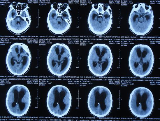 脑外伤后硬膜下积液颅骨修补,颅骨修复手术失败导致脑积水