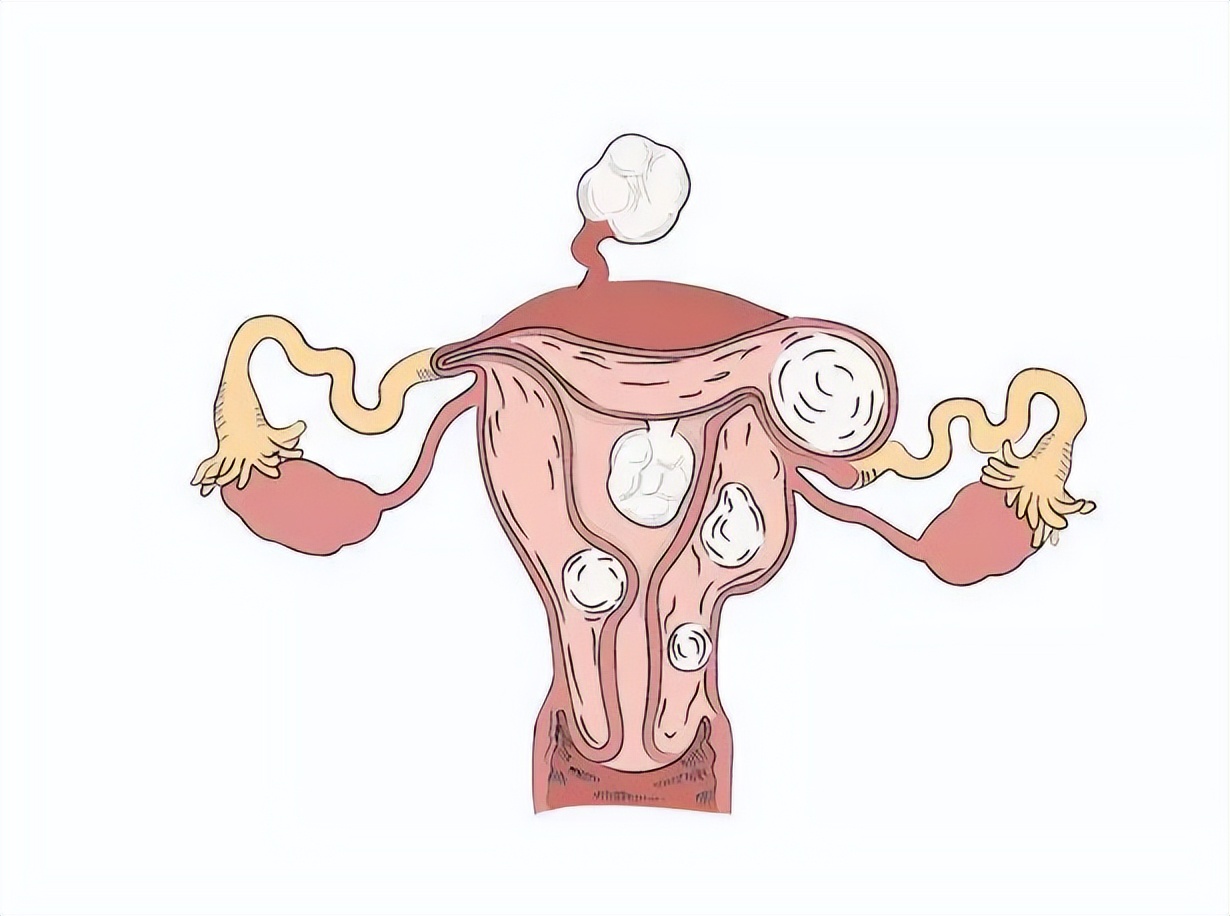 10年没治疗，子宫肌瘤长到4斤，如6个月的婴儿！手术取出109颗