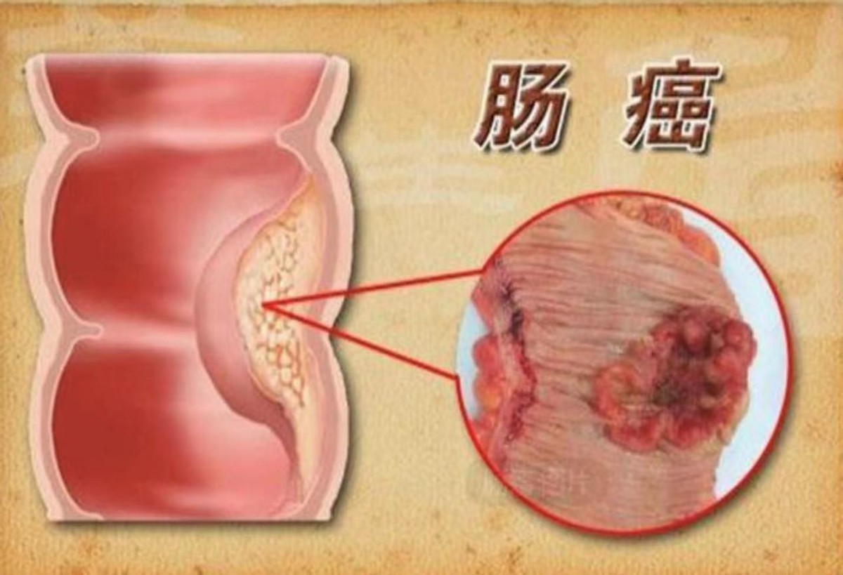 牛肉是致癌还是营养,牛肉含有营养价值吗