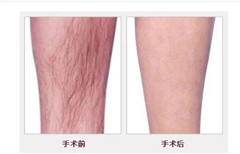 “她”切除了阴茎和*丸睾**，却成了“太监”，变性和阉是一回事儿？