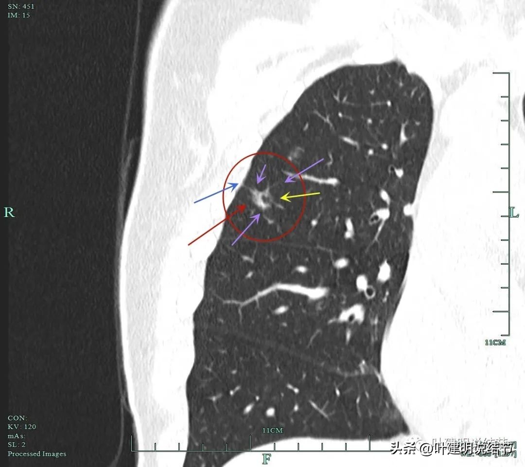 磨玻璃结节伴有增生是癌症吗,磨玻璃结节会是别的癌转移的吗
