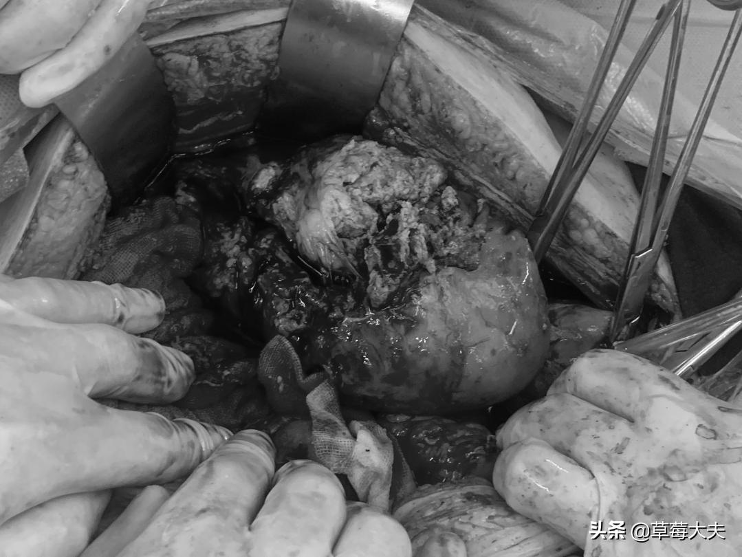 肚子莫名长大！40岁姐姐取出柚子大肿瘤，一查是肠道癌症跑到卵巢