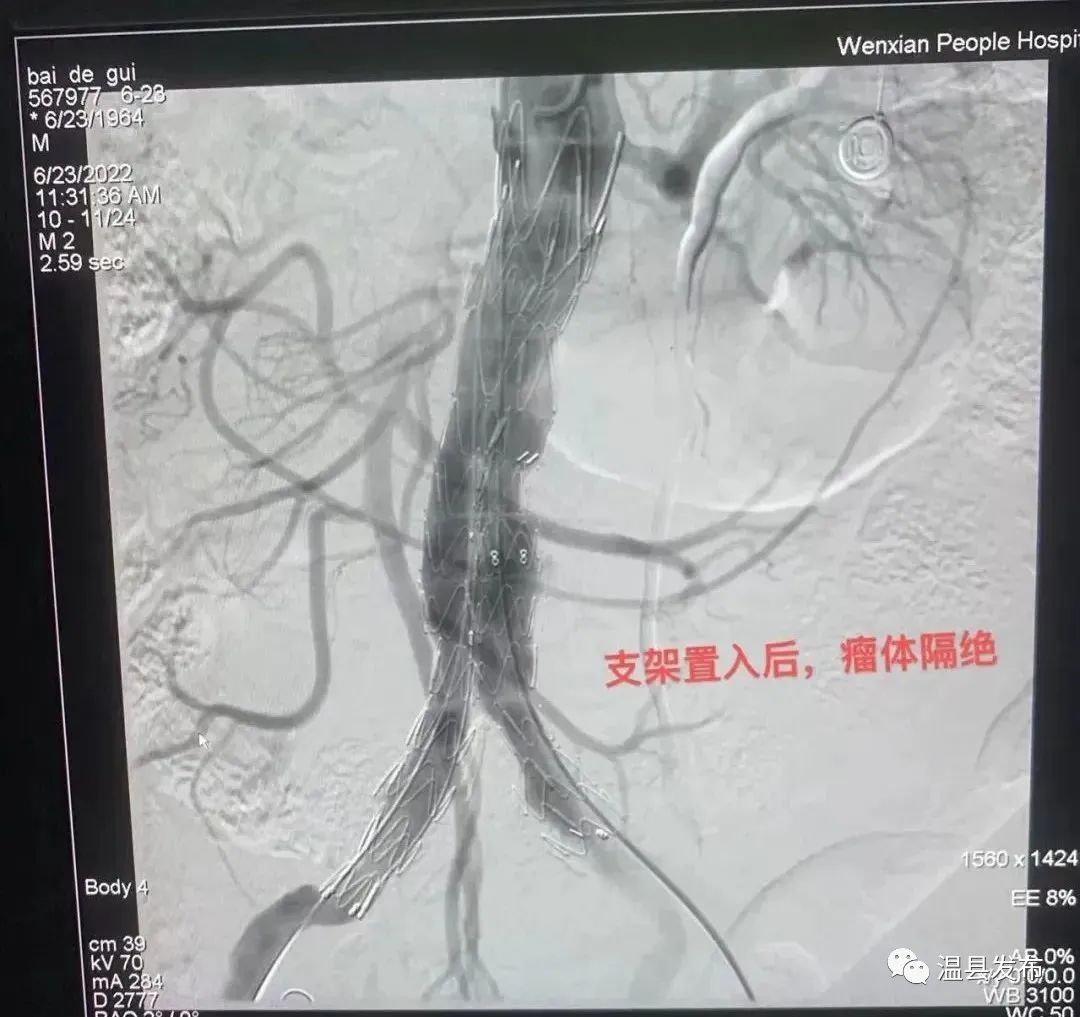 首例成功换脸手术,首例手术