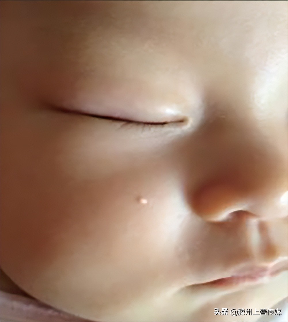 脂肪粒的形成原因及解决方法,长了脂肪粒要去看医生吗