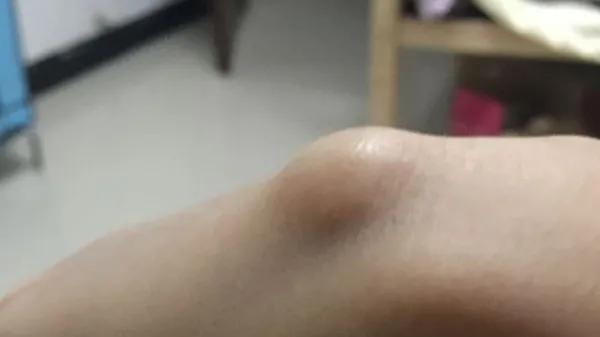 手背上长了个小凸起的包不痛不痒,手背突然起了个包
