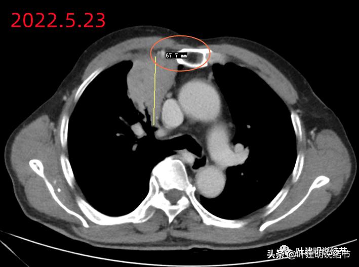 经验：肺占位超6厘米，不是癌还会是什么？临床上仍得多个心眼