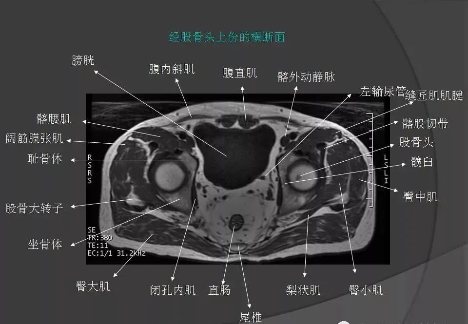 女性盆腔ct连续断层解剖图,盆腔mri影像病例分析