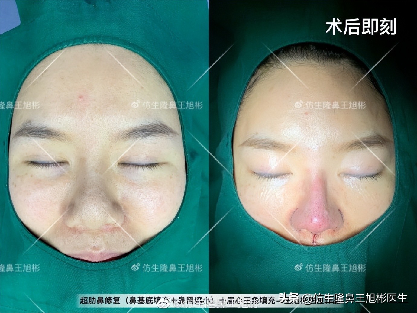 做一次鼻头缩小要多少钱好,可以只做鼻头缩鼻翼吗