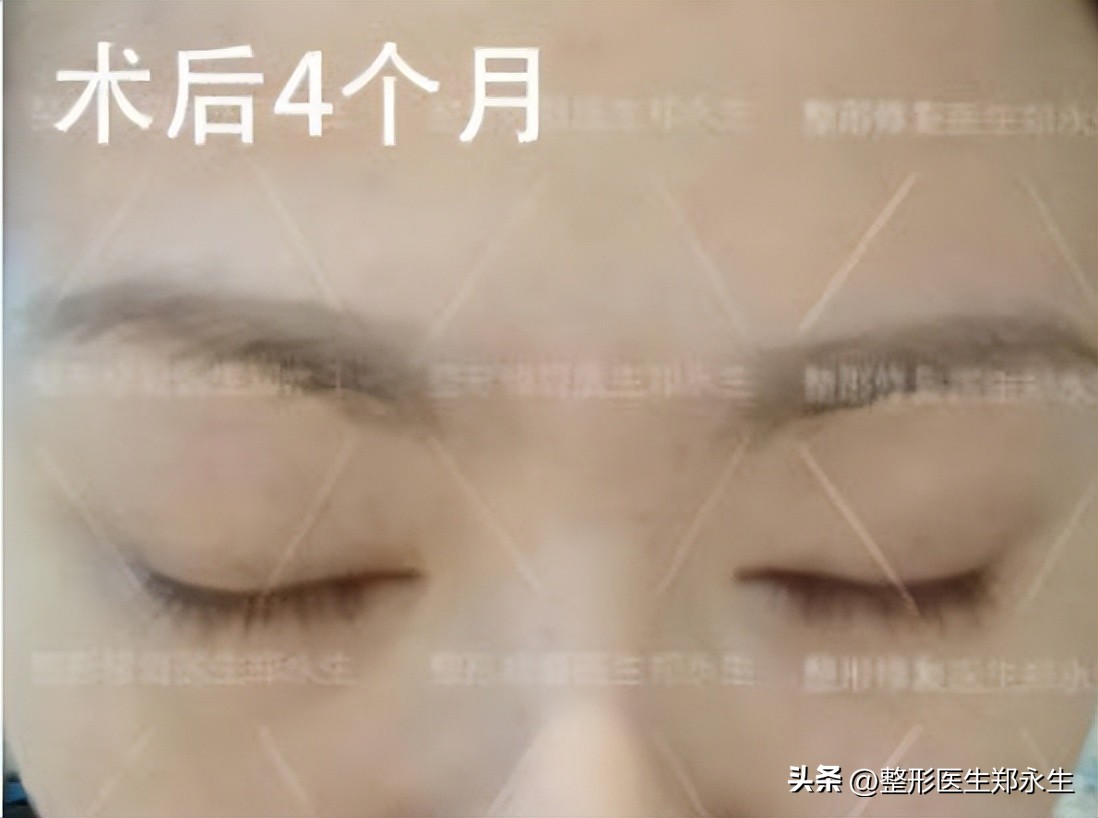 双眼皮修复手术真的很难吗,双眼皮整形真实修复过程